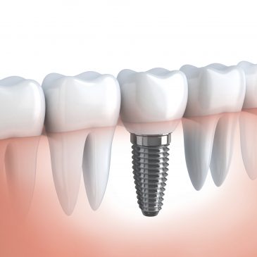 Dental Implants in Philadelphia, PA: When Are They Necessary?